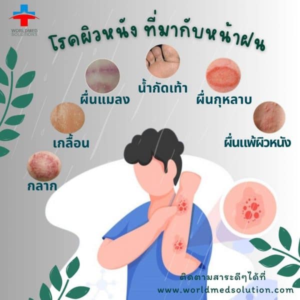   โรคผิวหนัง ที่มากับหน้าฝน