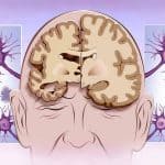 บำรุงสมอง ป้องกันอัลไซเมอร์