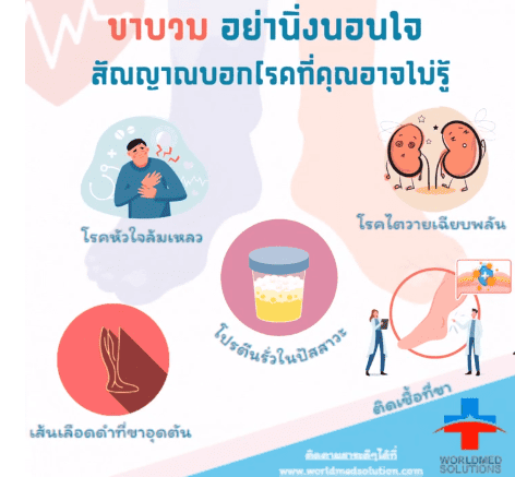 ขาบวม อย่านิ่งนอนใจ สัณญาณบอกโรคที่คุณอาจไม่รู้